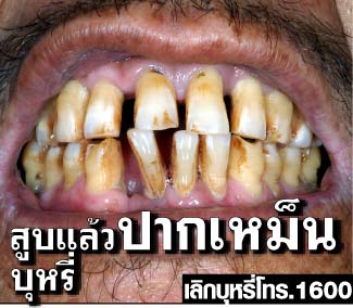 Thailand 2009 Health Effects mouth - bad breath, gross